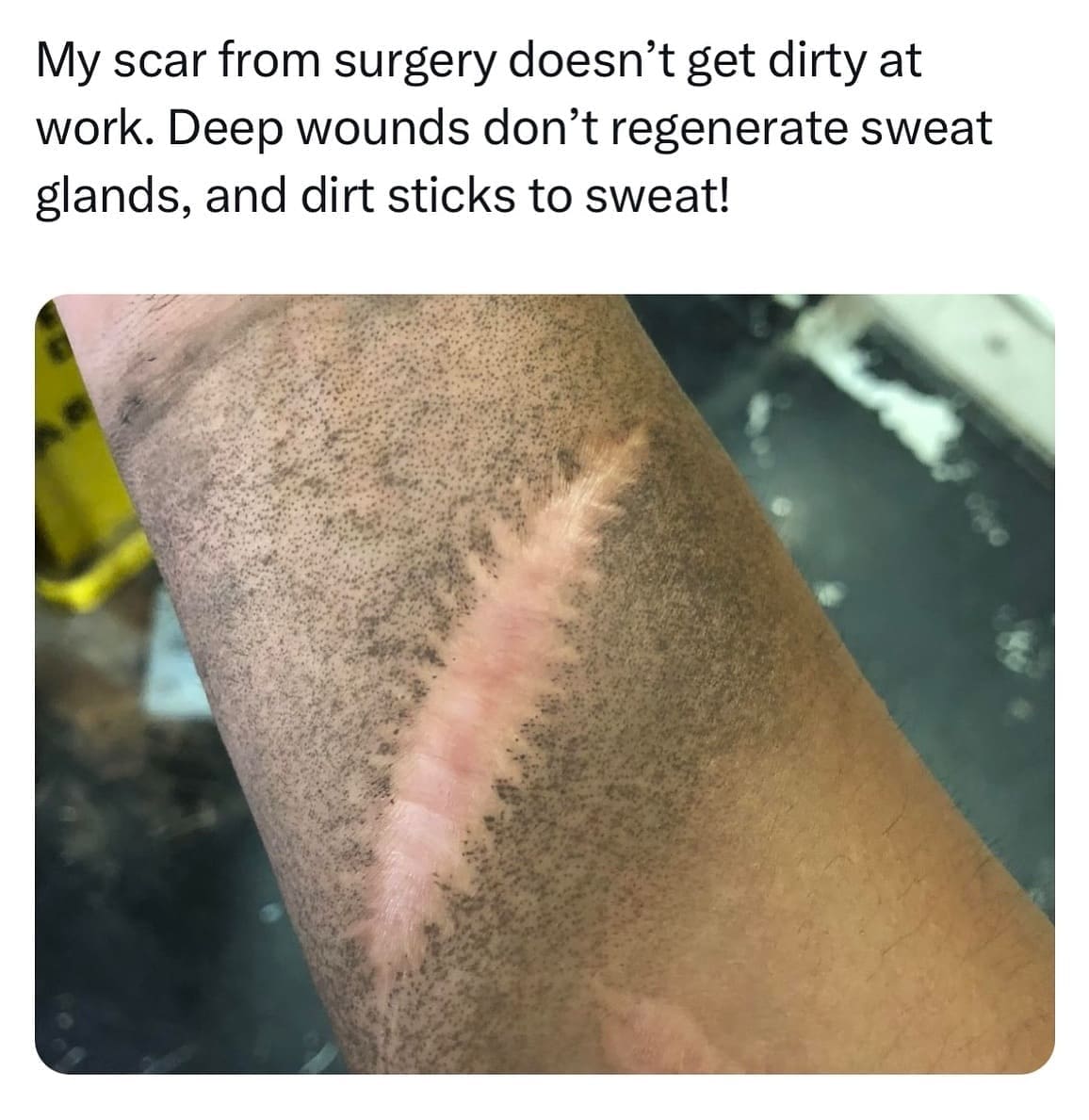 funny pics My scar from surgery doesn't get dirty at work. Deep wounds don't regenerate sweat glands, and dirt sticks to sweat!