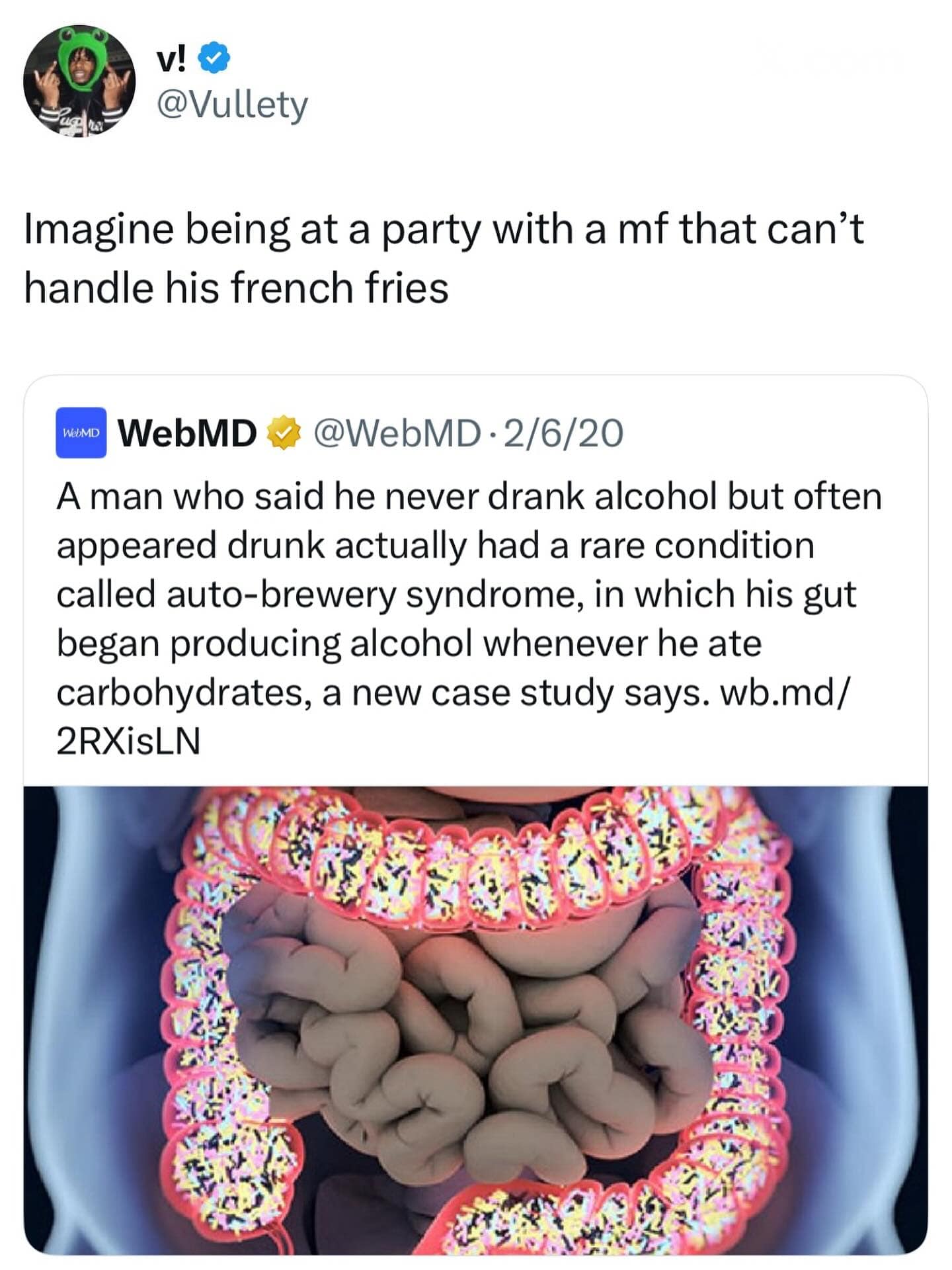 A meme dump tweet about a man with auto-brewery syndrome who gets drunk from french fries.