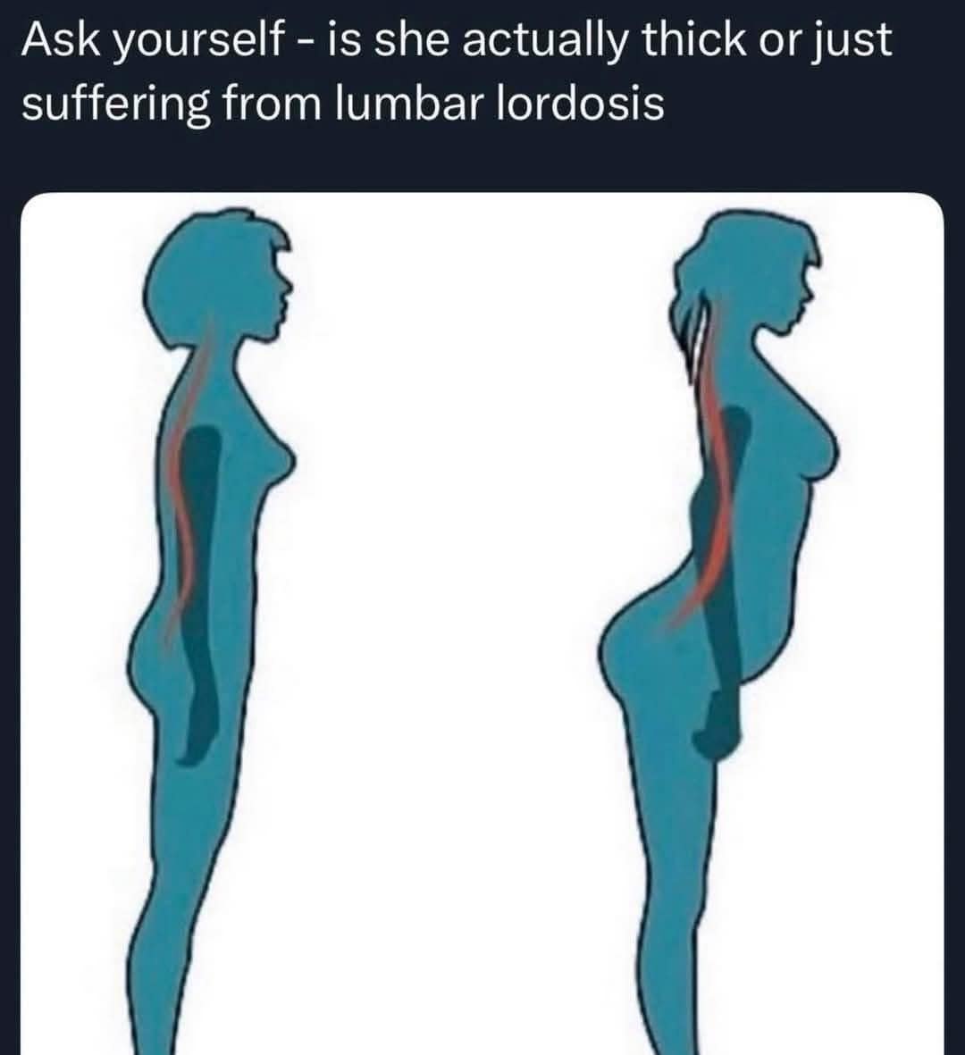 A funny meme that uses a medical diagram of lumbar lordosis to question modern beauty standards and poses.