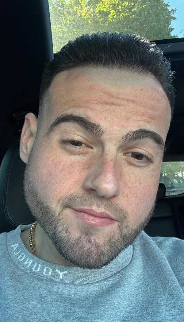 A man with a very high and tight haircut, whose face appears swollen or oddly filtered around the jaw.