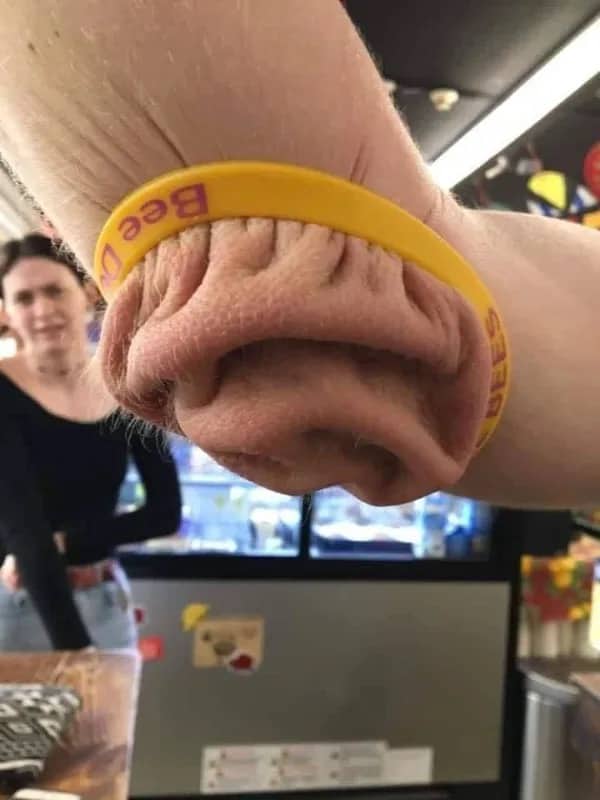 Close-up of a person's wrinkled elbow skin squeezed through a yellow rubber Bee Dizzies bracelet.