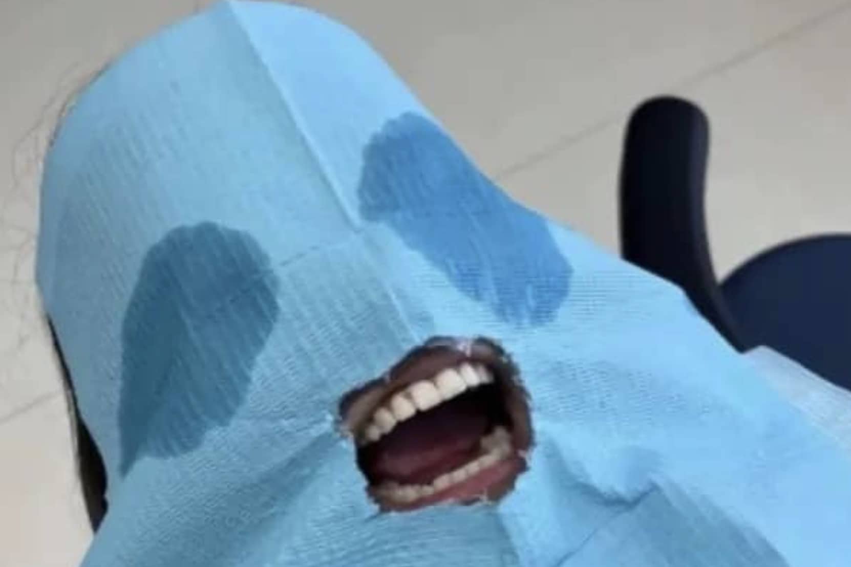 A person at the dentist covered by a blue paper bib with wet spots and mouth exposed.