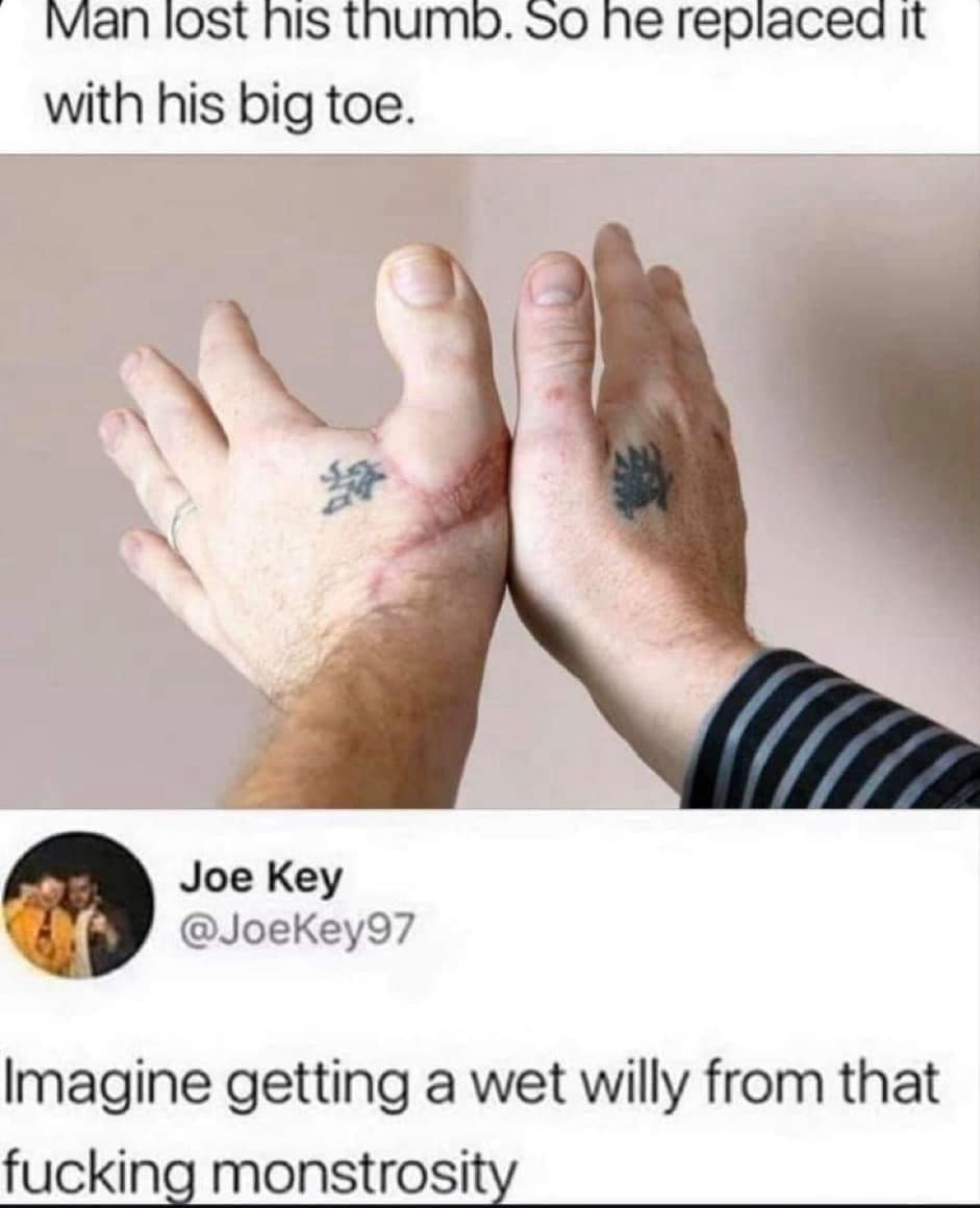 shocking medical photo of a hand with a "thumb" replaced by a big toe is paired with a cursed comment about the horror of a "wet willy" in this classic meme